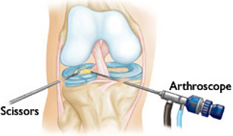 knee-arthroscopy