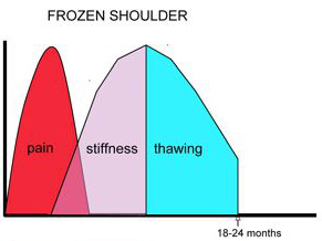 frozen-shoulder1
