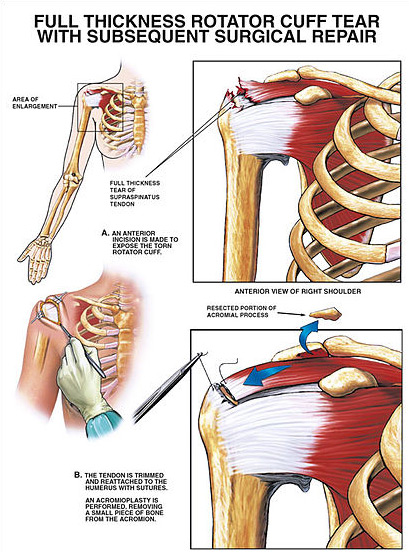 Rotator Cuff Tear - Hobart Orthopaedics